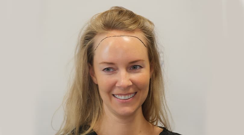 Hair Transplantation (FUE & DHI)