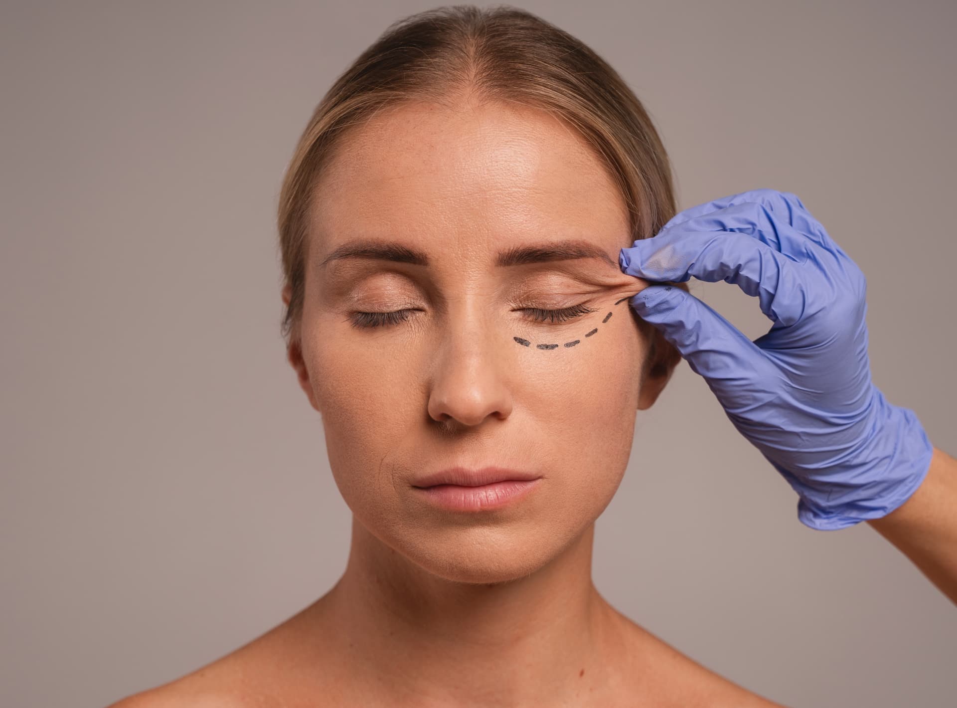 Blepharoplasty