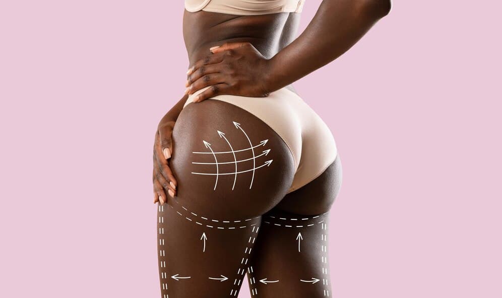 Brazilian Butt Lift (BBL)