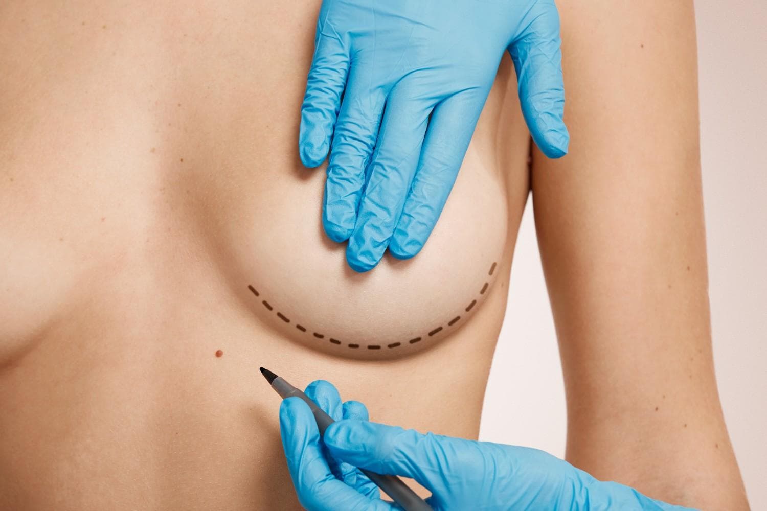 Breast Lift