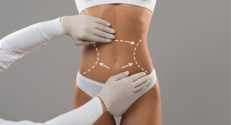 Tummy Tuck (Abdominoplasty)
