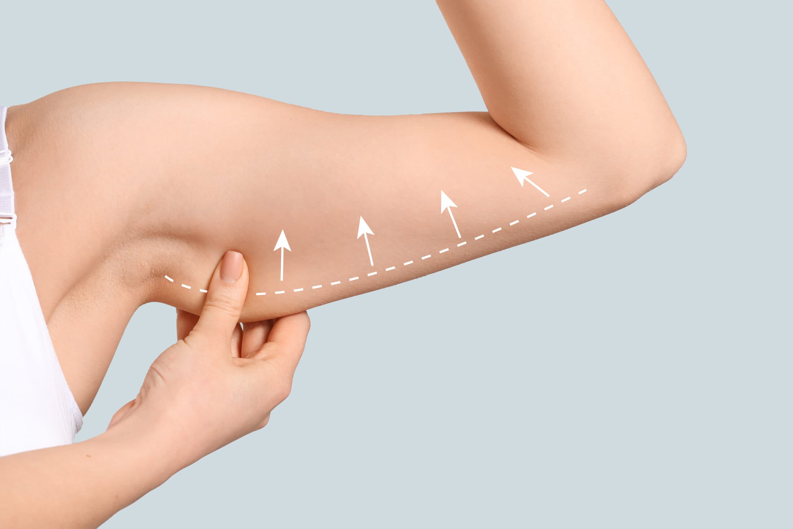 Arm Lift (Brachioplasty)