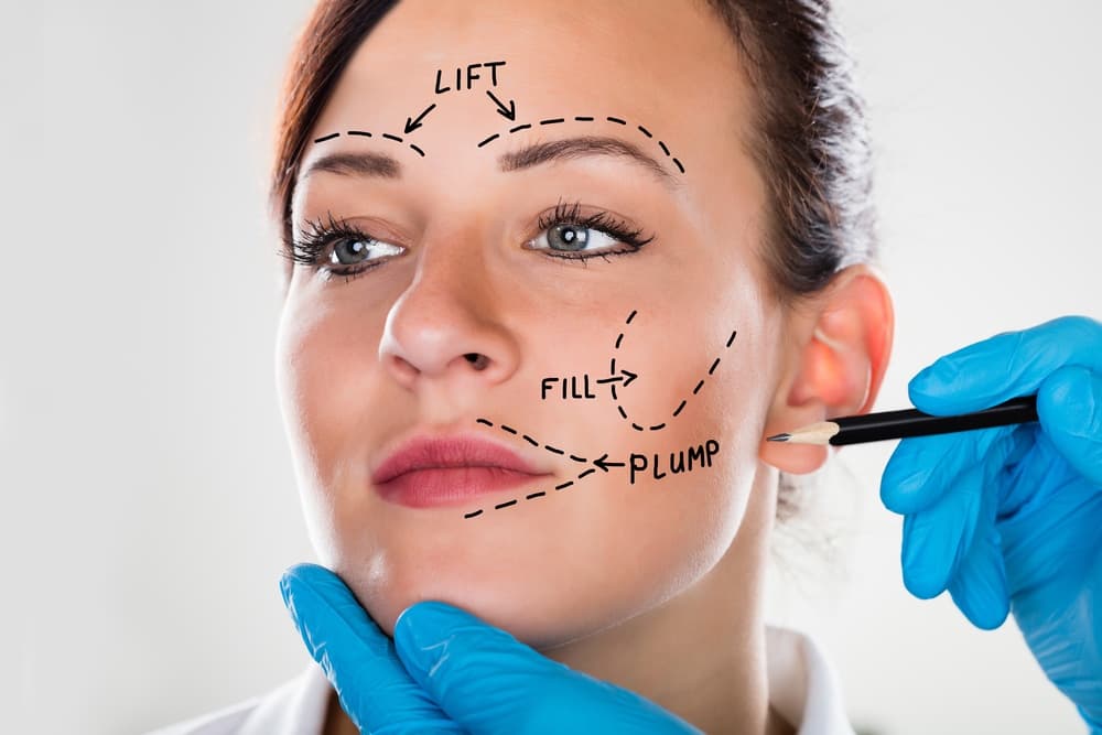 Facelift