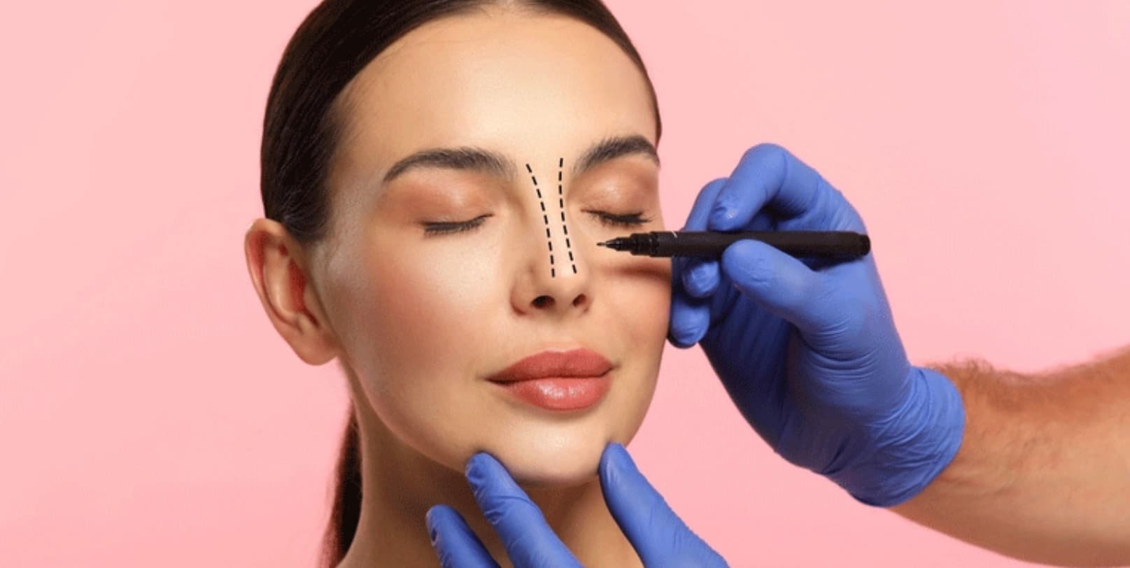Rhinoplasty